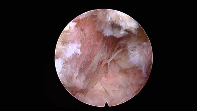 Bleeding endplates, endoscopic view