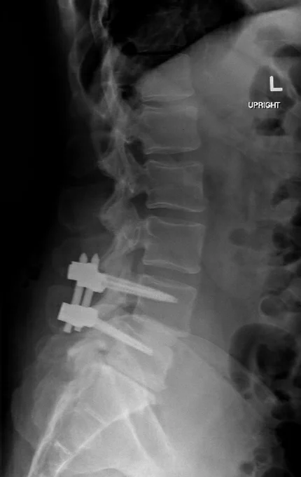 Post op upright XR