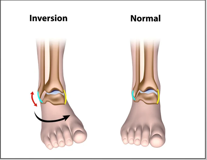 Why Choose Footlevers Custom Orthotics?
Footlevers orthotics are not just ordinary shoe inserts. They are custom-made to address specific pain points such as:
Plantar fasciitis & ankle pain
Knee pain & shin splints
Hip pain
Sacroiliac & lower back pain
Sciatica & disc herniations
Our patients often report a significant reduction in pain and improved daily function, allowing them to walk, work, and play without discomfort.