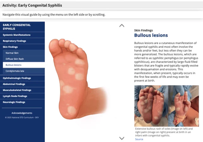 Learn how to screen and treat pregnant women with syphilis and neonates with congenital syphilis via NEW National STD Curriculum lesson to address recent 8-fold increase in reported congenital syphilis cases in the U.S.
