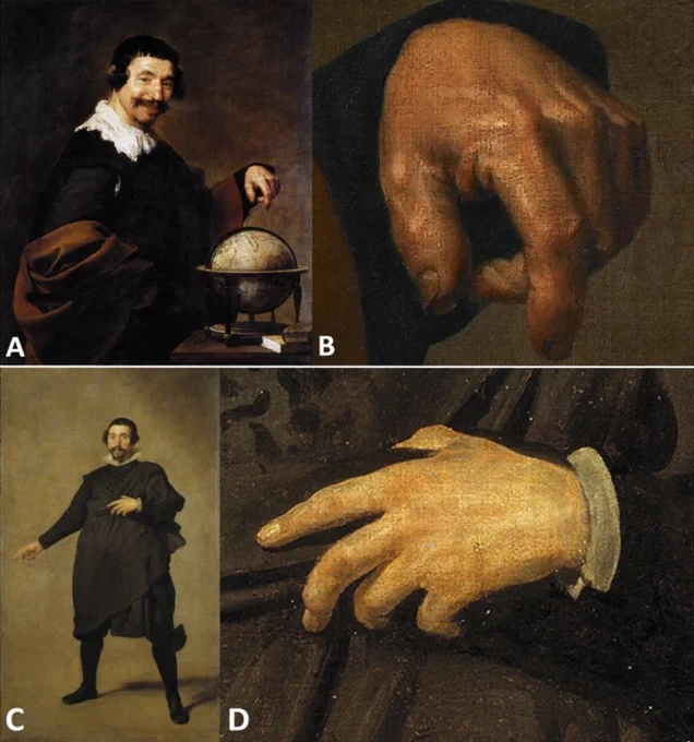 (A). "Democritus" (Accession number: 822.1.16) by Diego Velázquez (c. 1630), 101 x 81 cm, Musée des Beaux Arts d’Orleans, France. (B) Detail showing gouty tophi level with the metacarpophalangeal and interphalangeal joints of the left thumb and the distal and proximal interphalangeal joints of the second finger of the left hand (as observable in the painting).