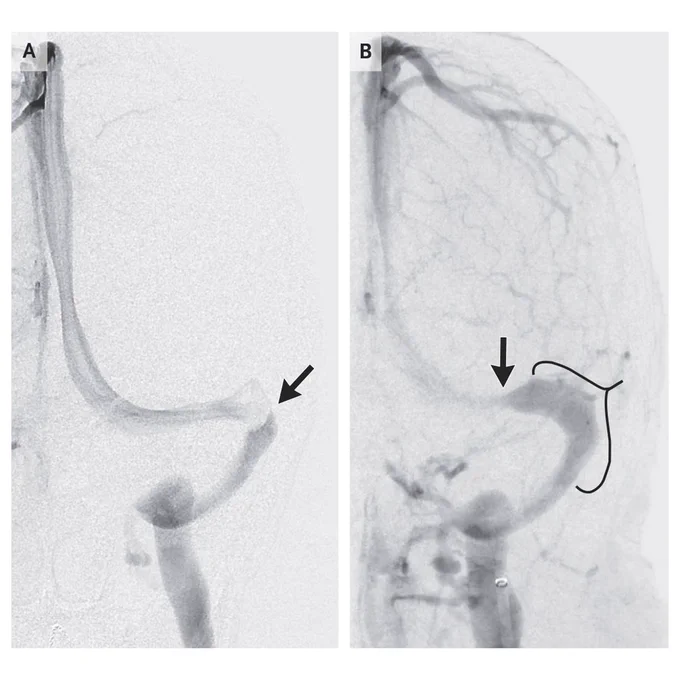 Panel A shows a catheter angiography image of the venous phase after contrast injection into the carotid artery in a patient, confirming stenosis of the distal left transverse sinus before treatment (arrow). A stent was placed because the patient’s lumboperitoneal shunt was occluded, but her vision continued to worsen. Panel B shows a follow-up study 6 weeks later with a new stenosis (arrow) upstream from the stent (bracket). A second stent (not shown) was placed across the new stenosis, but the patient’s visual acuity continued to decline. A month later, the lumboperitoneal shunt was revised, leading to partial recovery of acuity to 20/60 in the left eye, but the visual field remained severely constricted (Panel B).