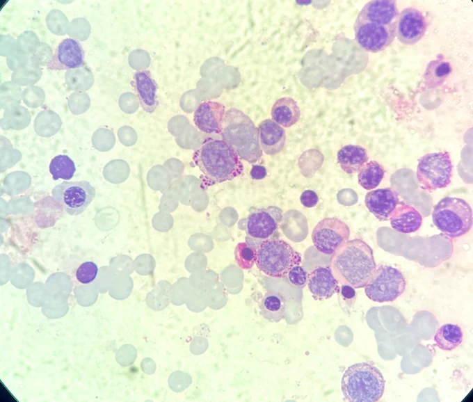 44 Female, known case of MDS IB2 after induction