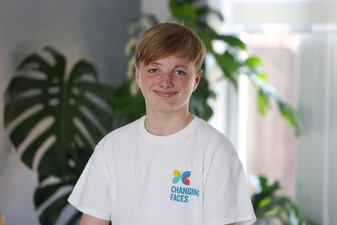 Charlie, a 15 year old with a facial scar, stands in a Changing Faces t shirt and smiles at the camera.