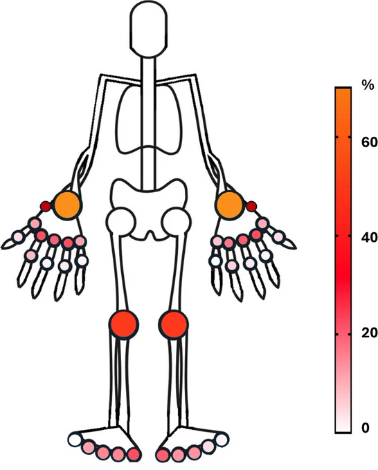 Prevalence of US detected grade ≥ 1 synovitis in systemic lupus erythematosus patients. Percentage refers to each specific joint out of the total analyzed joint. For instance: we detected a Grade ≥ 1 synovitis in R MCP 2 in 14 patients (14/119; 11.7%). 