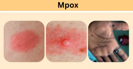 Mpox Clinical Recognition & Testing Oveview: http://bit.ly/4hozywn
