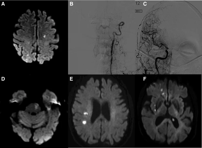Figure 1 in Hooper and Hoshina et al.