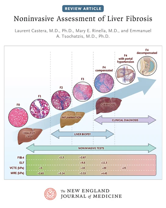Review Article
Noninvasive Assessment of Liver Fibrosis
Laurent Castera, M.D., Ph.D., Mary E. Rinella, M.D., and Emmanuel A. Tsochatzis, M.D., Ph.D.

A figure showing the diagnosis, staging, and progression of liver fibrosis.

The NEJM identity sits at the bottom.