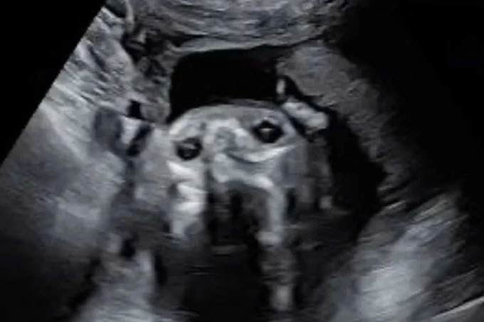 a black and white sonogram of a human baby at 20 weeks. it looks oddly like a dog with two black eyes, a snoot, and a little grin.