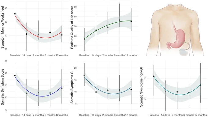 Summary
• Gastric electrical stimulation (GES) is an effective and safe treatment option for patients with refractory nausea and vomiting.
• Non-gastrointestinal somatic symptoms are not associated with response to GES therapy.
• Children receiving GES therapy experienced transient improvement in somatic symptoms during the first year with GES.