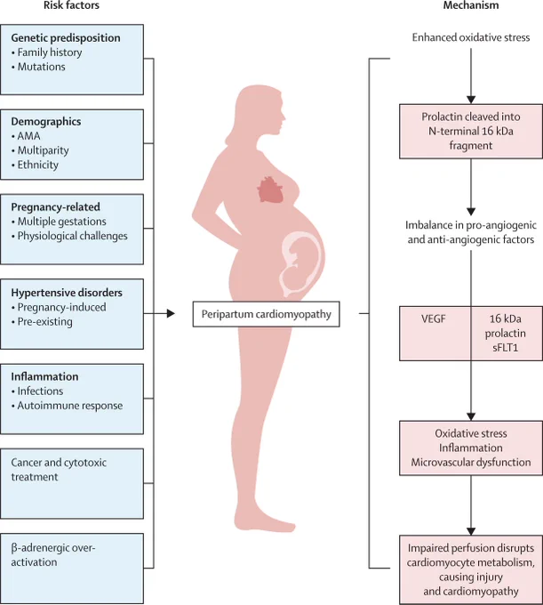 Figure showing risk factors and pathological mechanisms linked to peripartum cardiomyopathy. Copyright: 2025 Elsevier Ltd. All rights are reserved.