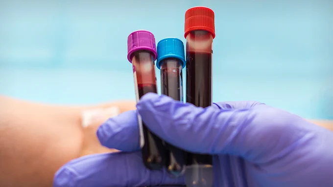 Hand wearing a medical glove, holding blood test tubes. 