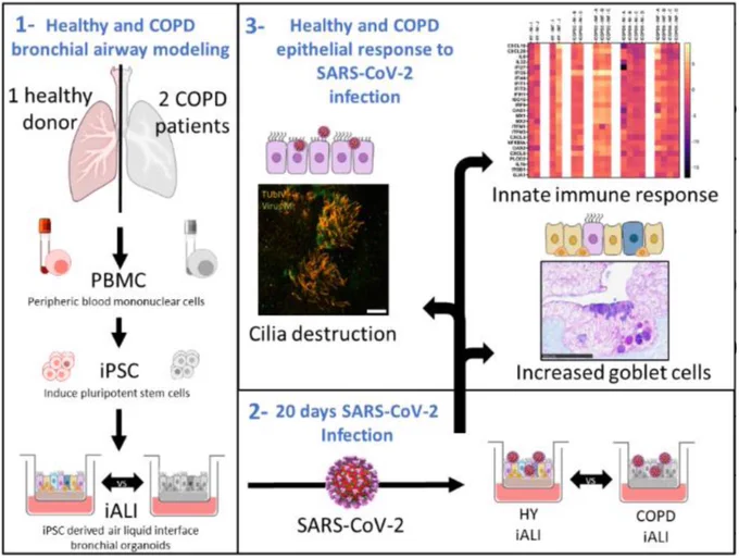 Graphical abstract from linked preprint. Schematic of healthy and COPD bronchial airway remodeling, collecting PBMCs from healthy donors and COPD patients, creating iPSCs, and using those iPSCs in an air-liquid interface to create bronchial organoids. Graphical representation of these organoids' epithelial responses to SARS-CoV-2 infection.