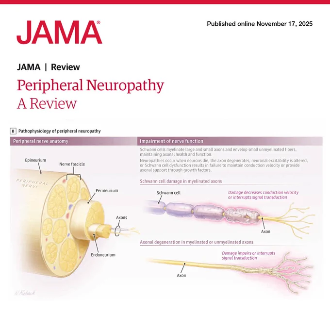 Illustration from JAMA's review on Peripheral Neuropathy shows nerve anatomy and function impairment. Labels include Epineurium, Perineurium, Axons, Schwann cells, and effects of axonal degeneration on signal transduction.