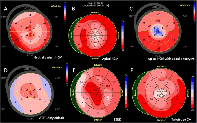 Aplicaciones clínicas de la ecocardiografía de deformación miocárdica: Declaración de consenso clínico ASE/EACVI-ESC