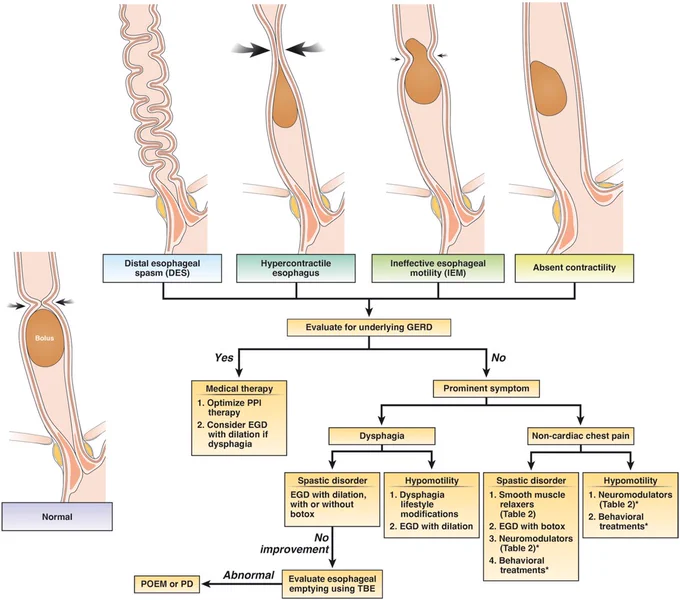 Algorithm for Diagnosis and Management of Esophageal Dysmotility Disorders