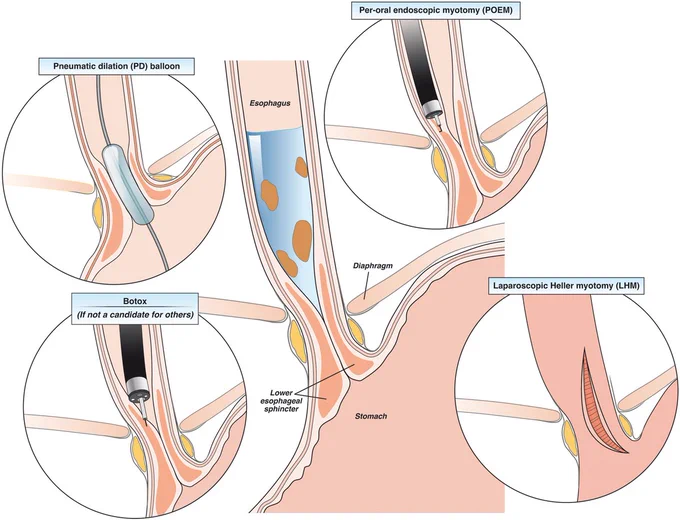 Algorithm for Diagnosis and Management of Esophageal Dysmotility Disorders
