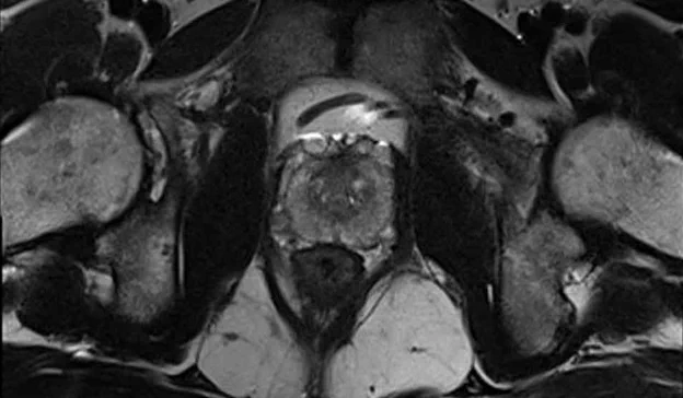 Close up MRI scan of a prostate.
