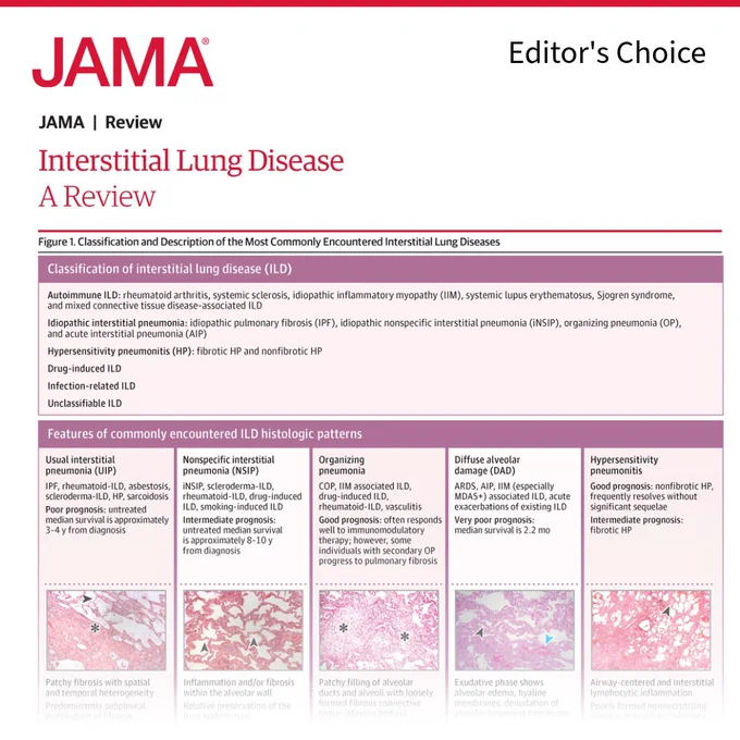 A page from JAMA reviews interstitial lung disease. It includes a classification of interstitial lung disease, features of ILD histologic patterns, and lists autoimmune, idiopathic, hypersensitivity, drug-induced, infection-related, and unclassifiable ILD.