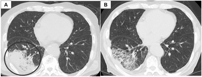 Cancer Reports https://doi.org/10.1002/cnr2.70420