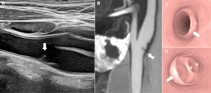 Figure. Multimodal imaging of a carotid web.