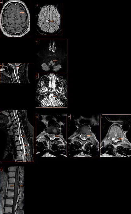 MRI of the head and spine. (a) Axial T1 post-gadolinium contrast of the brain. Focal leptomeningeal enhancement high left frontal lobe. (b) Axial T2 fluid-attenuated inversion recovery of the brain. A focal high signal lesion at the parafalcine cortex right frontal lobe 

Hear more in the article.