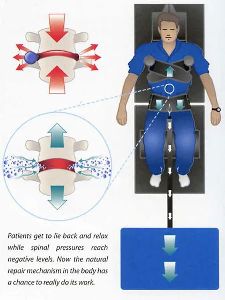 Image shows a patient lying comfortably on a spinal decompression table while a chiropractor carefully adjusts the equipment. The patient appears relaxed as the table gently stretches the spine. Text overlay reads: “End-of-Year Spinal Decompression Special $149 – Don’t Let Your Benefits Go to Waste!”
As 2025 comes to a close, Los Angeles Spinal Decompression® reminds patients to use any remaining Flexible Spending Account (FSA) or insurance benefits before they expire. This is the ideal time to address chronic back pain, sciatica, tech neck, or other spinal issues. Treatments include FDA-cleared spinal decompression, cold-laser therapy, in-office digital X-rays, and personalized chiropractic care. Many PPO insurance plans cover spinal decompression, and staff can assist with benefit verification. Appointments are limited, with last slots at 2:30 PM. Special offer: $149 per treatment (minimum 10 treatments). Prioritize your health, reduce pain, restore mobility, and start 2026 