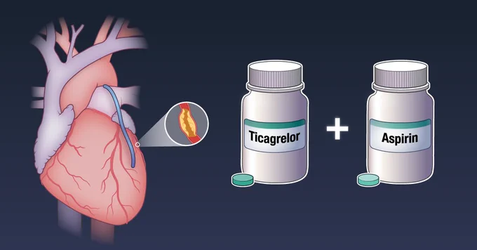 A visual representation of the TACSI trial, which assessed whether dual antiplatelet therapy after CABG for acute coronary syndrome reduces adverse events as compared with aspirin alone.