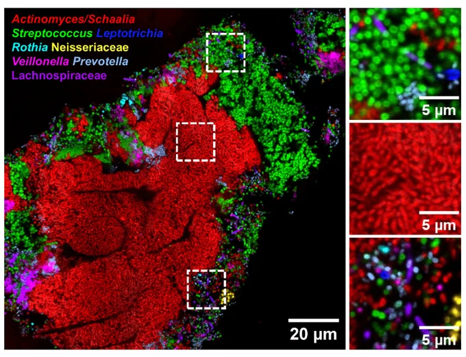 Sectioning enables visualization of complex bacterial communities. Five-micron-thick sections of tongue dorsum biofilm hybridized with probes targeting the problematic Gram-positive bacteria Actinomyces, Schaalia, and Streptococcus, along with six other abundant taxa. Actinomyces and Schaalia are detected as individual branching rods with a strong signal, while Streptococcus cocci exhibit a strong and homogeneous signal. Clusters of intermixed taxa with distinct signals are also observed. Right panels: high magnification images of the dotted squares in the left panel.
