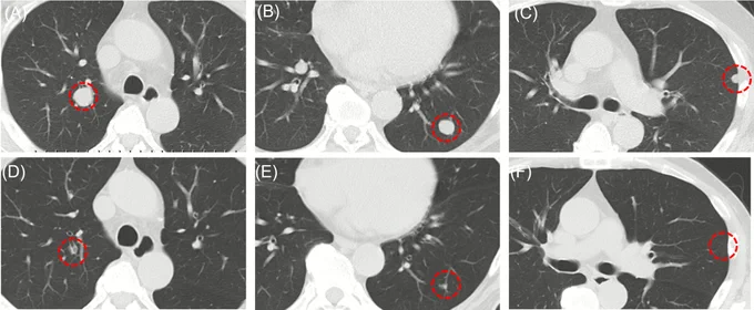 Mitsui et al., Cancer Reports; https://doi.org/10.1002/cnr2.70437
