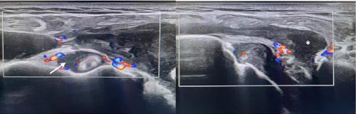 Ultrasound scan of the left shoulder showing subacromial-deltoid bursitis and tenosynovitis of the long biceps tendon