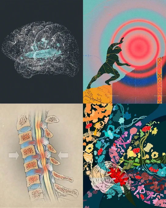 Four-panel collage featuring (clockwise from the top left): an illustration highlighting the superior temporal gyrus, a region that helps the brain understand speech; an illustration representing chronic pain as a rock that a person is lifting up a hill; an illustration depicting protein molecules emerging from a brain; and an illustration depicting cervical spondylotic myelopathy.