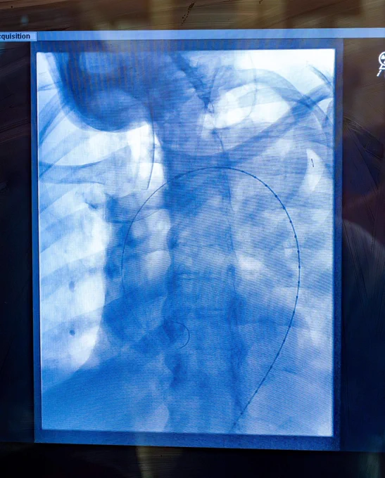 X-ray image showing the chest cavity with clear views of the spine, ribs, and a heart.