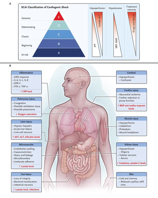 An illustration of organ involvement and staging of cardiogenic shock.