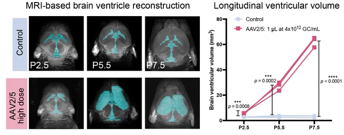Representative 3D reconstructions of brain ventricles from control and high-dose AAV2/5-injected pups at 2, 5, and 7 days post-injection (P2.5, P5.5, P7.5). Quantification of total ventricular volume across time points. (n = 3 per condition)