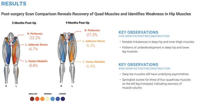 An example case study from Springbok Analytics showing two lower extremity muscle scans, with automated artificial intelligence analysis. The muscle volume asymmetries between left and right sides are contrasted for this athlete at 5 months and 9 months post ACL surgery. 