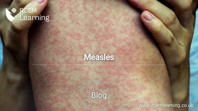 ID: RCEMLearning Logo in the top left corner. There is a shield and a small rose, all in white

A picture of an adult holding a child with measles. They are red blotchy spots all over their back.  

Alt Text: Measles. Blog