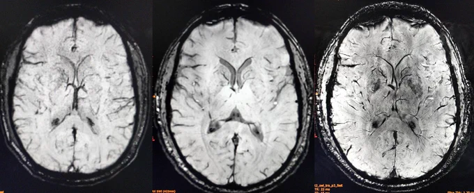 1T MRI image (L) 3T MRI image (middle) 7T MRI (R)
