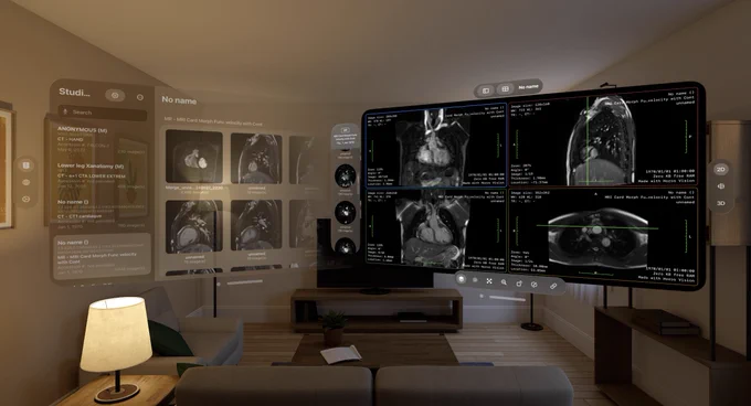 The image shows a modern living room with two large, Apple Vision Pro windows floating above a coffee table. This advanced interface displays several medical images, specifically MRIs, suggesting that the room's occupant might be reviewing medical data, possibly for work or study. On the display, multiple panels show detailed scans of human anatomy with various measurements and notes.