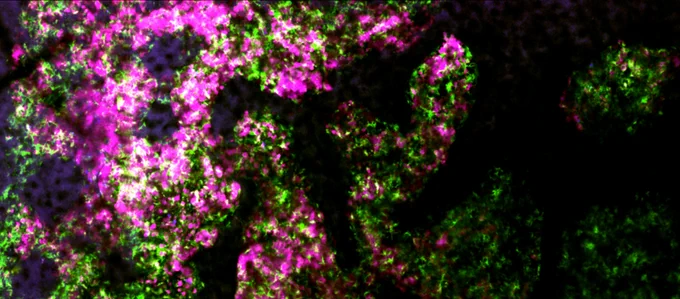 	Image capturée in vivo suite à l’injection de l’anticorps anti-CD20 représentant les cellules cancéreuses (en magenta) et les macrophages (en vert) s’attaquant aux cellules tumorales. 
© Institut Pasteur – Unité des Dynamiques des réponses immunes 