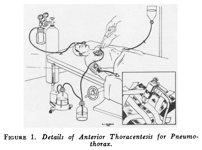 Figure 1. Details of Anterior Thoracentesis for Pneumothorax.