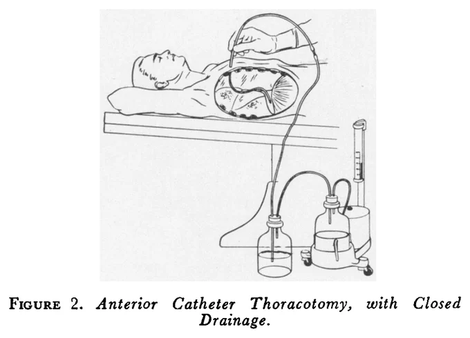 Figure 2. Anterior Catheter Thoracotomy, with Closed Drainage.