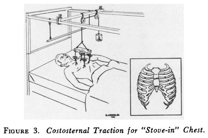 Figure 3. Costosternal Traction for "Stove-in" Chest.