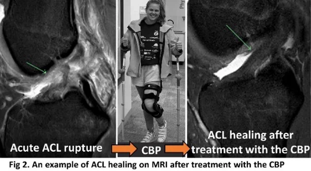 https://bjsm.bmj.com/content/57/23/1490