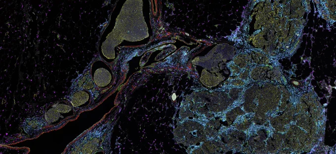 15-plex whole slide imaging of breast ductal adenocarcinoma by Orion, the spatial biology imaging system by RareCyte. Learn more at AACR.