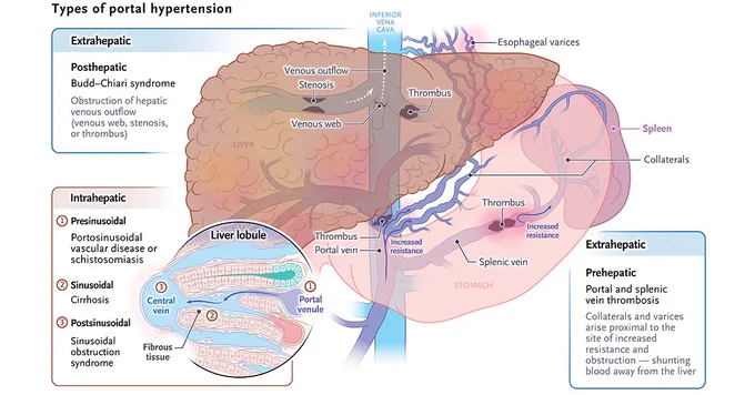Visual representation of “portal hypertension”