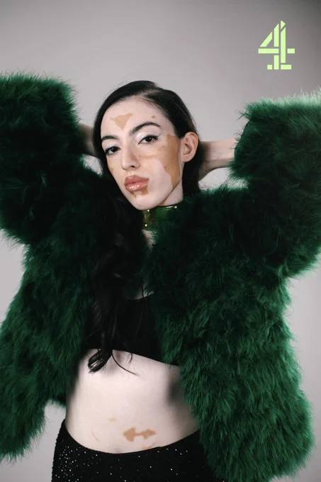 Image of female model Jasroop wearing a shiny gold and black leather choker with a fluffy green jacket, black top and black skirt. Jasroop has the skin condition vitiligo and poses with both hands behind her head.