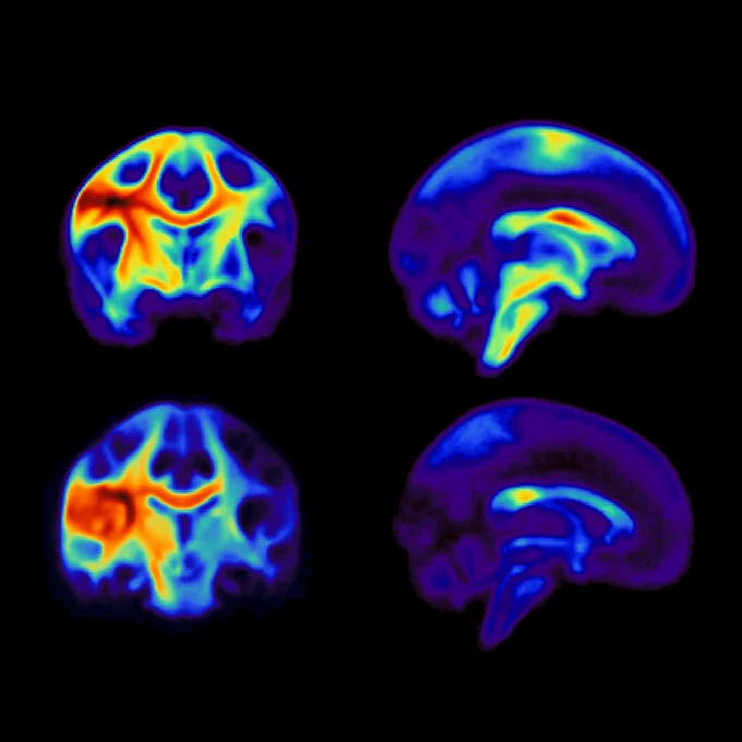 Four images of the brain set against a black background. The images show a visualization of probability density maps for connections starting at seed regions in the dorsal (upper) and ventral (lower) laryngeal motor cortex. Areas with more connections are in red, areas with fewer are in blue. The maps were derived from probabilistic fiber tracking based on 136 DTI datasets.