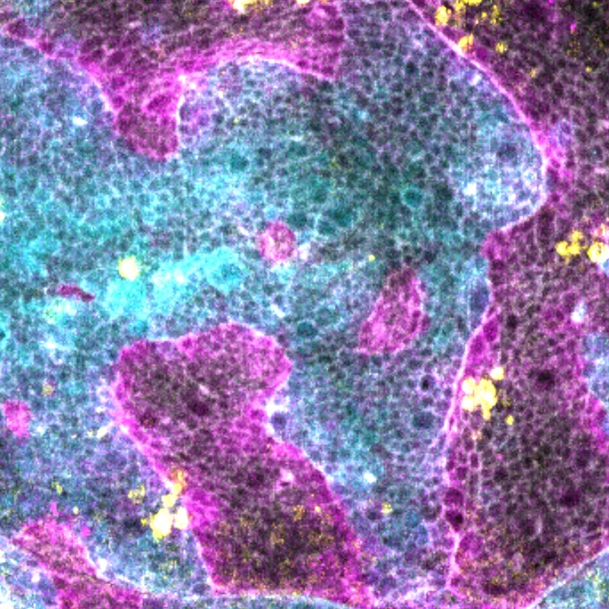 The image shows a zoomed in part of a wing imaginal disc with ectopic Robo2 expressing cells in cyan, JNK signaling activity in magenta, actomyosin (phalloidin staining) in grey and cleaved Dcp-1 (apoptosis) in yellow. 