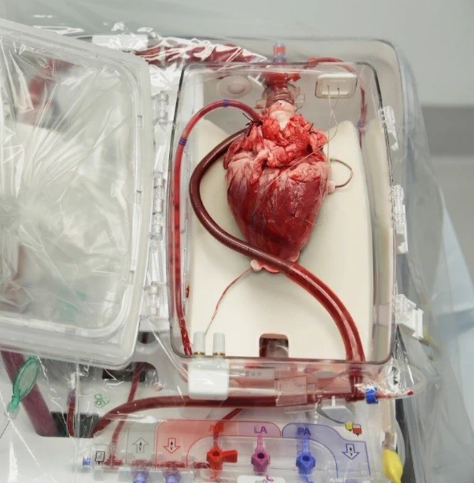 We are optimistic that this groundbreaking procedure will increase the heart transplant donor pool and allow more lifesaving heart transplants each year.